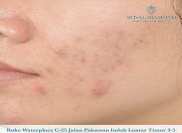 Acne Vulgaris (Jerawat)