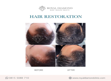 Hair Restoration Treatment