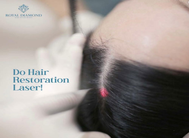 Atasi Rambut Rontok dengan Hair Restoration Laser!