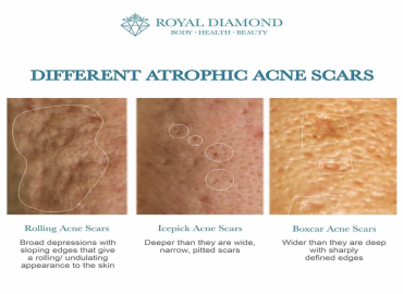 Acne Scar